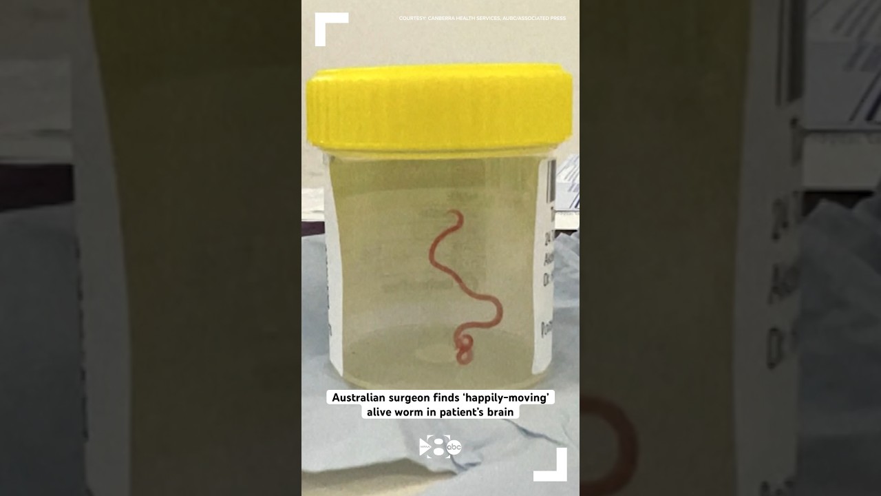 Australian surgeon removes ‘happily-moving’ alive worm from patient’s brain